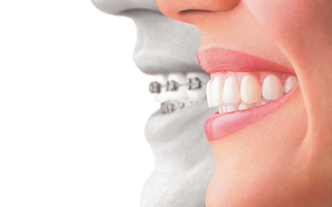 Ask Your Odessa, Midland and Lubbock Dentist: What’s the difference between Invisalign and Metal Braces?