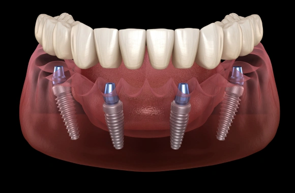Dental implant model showing prosthetic teeth on implant posts against pink gum tissue.
