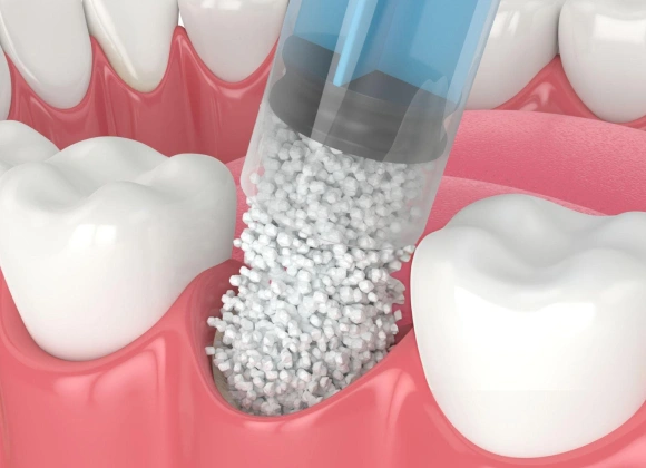 Dental implant procedure showing bone graft material between teeth in gum tissue.