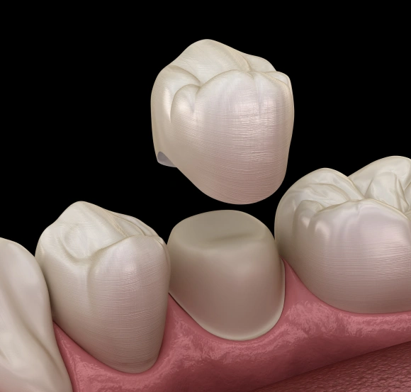 Dental crown placement illustration showing ceramic tooth restoration on gum model.