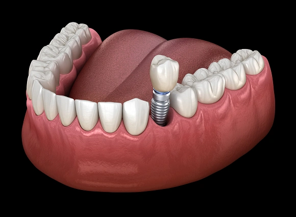 Dental implant model showing artificial tooth placement in jawbone with gum tissue on black background.