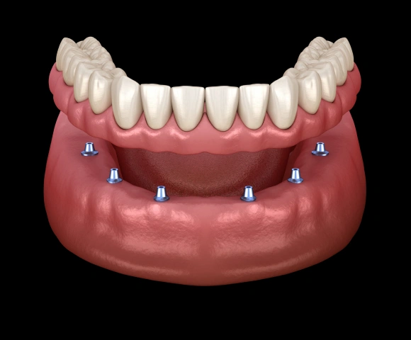 Dental implant model showing prosthetic teeth anchored to lower jawbone with four implant posts.
