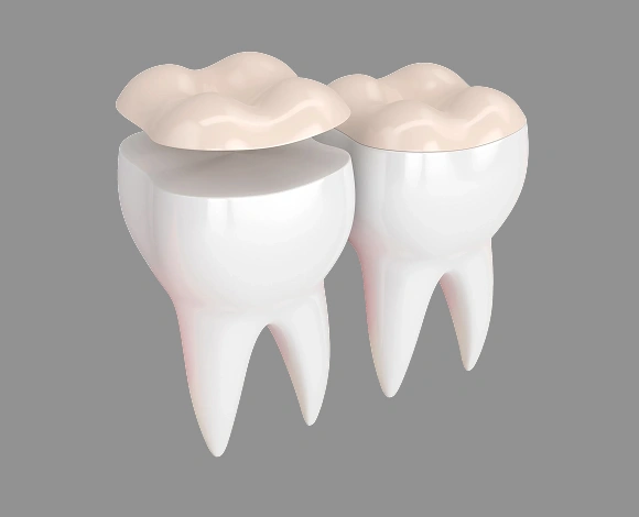 Two white 3D teeth illustrations with beige crowns on gray background, dental treatment concept.