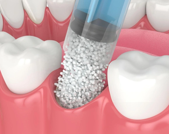 Dental implant procedure showing bone graft material being placed in gap between teeth.