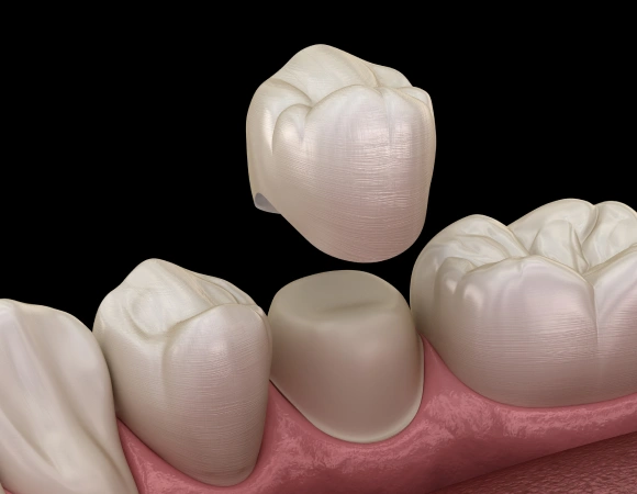 Dental crown restoration showing tooth-colored porcelain crown placement on model with pink gum tissue.