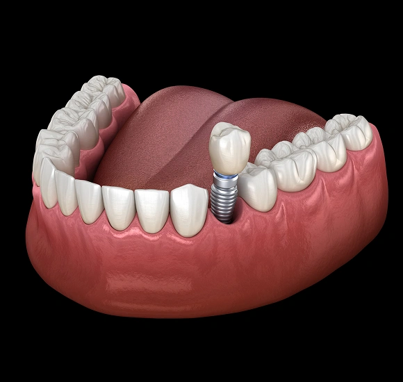 Dental implant model showing prosthetic tooth replacement in jawbone structure on black background.