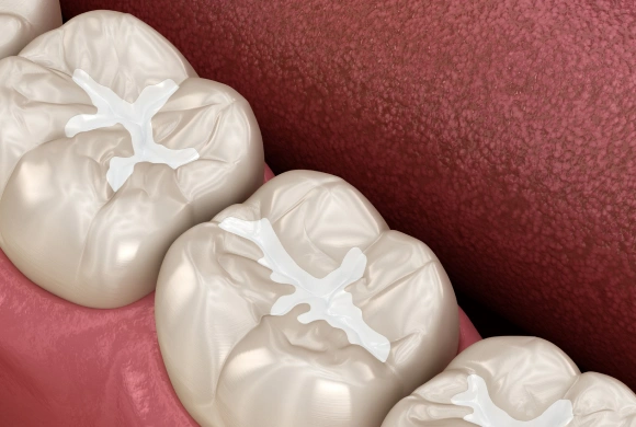 Three dental crowns or caps displayed on pink dental model background, showing prosthodontic dental work.