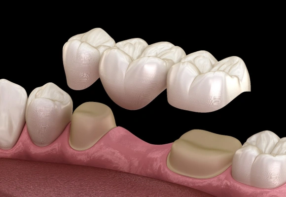 Dental bridge restoration showing ceramic crowns replacing missing teeth on gum model.