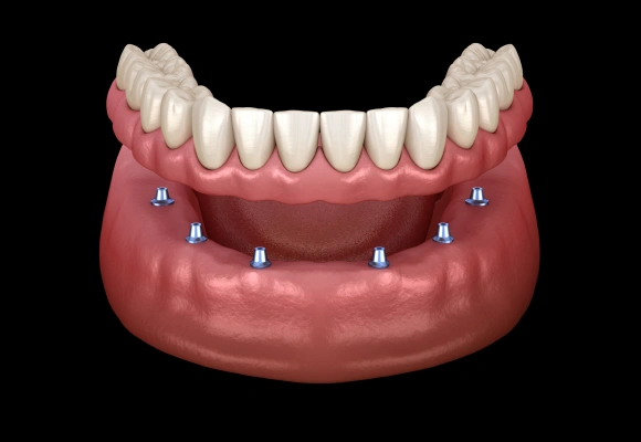 3D dental implant model showing prosthetic teeth attached to lower jaw structure with implant posts marked.