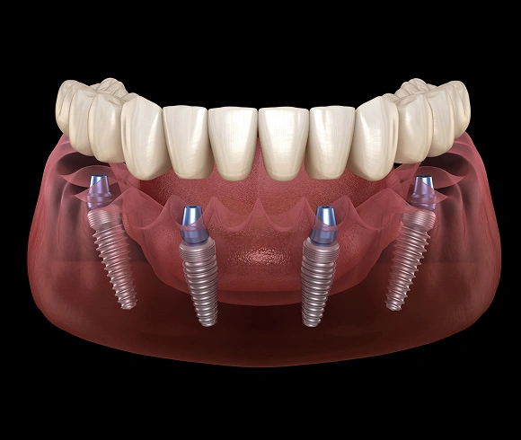 Dental implant model showing prosthetic teeth on implant posts in gum replica.