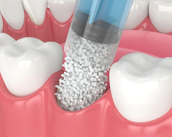 Dental implant procedure showing bone graft material being placed in jaw socket between teeth.