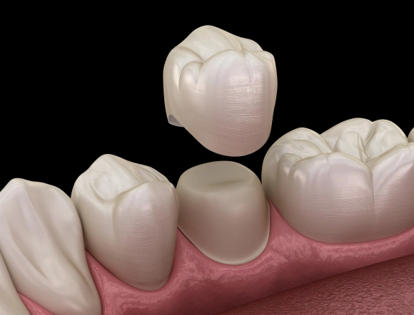 Dental crowns displayed on a model gum showing tooth restoration options and placement.