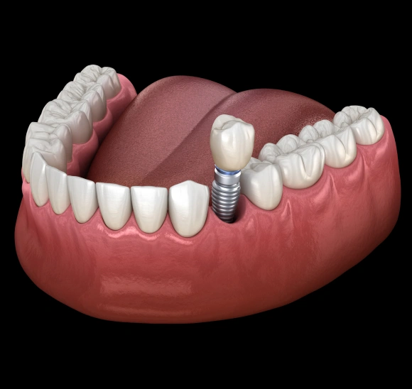 Dental implant model showing artificial tooth fixture embedded in gum tissue with surrounding natural teeth.
