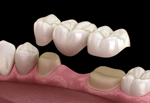 Dental crowns and bridges displayed on pink gum model showing tooth restoration options.