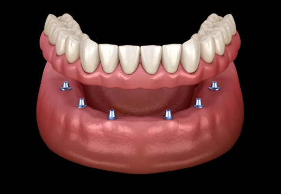 3D dental implant model showing lower jaw with eight implant posts positioned in pink gum tissue supporting prosthetic teeth.