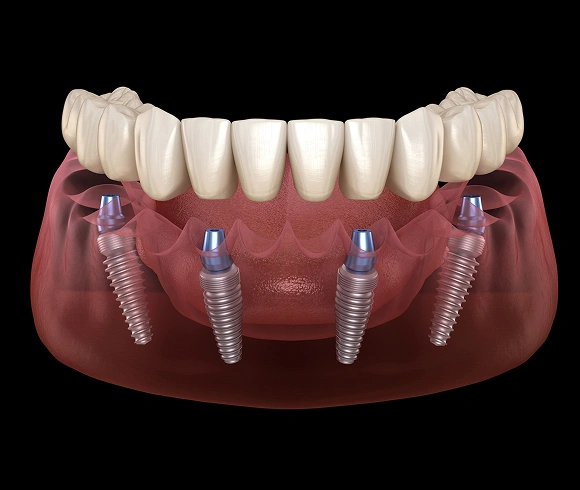 Dental implant model showing four titanium implants supporting a full upper denture prosthesis.