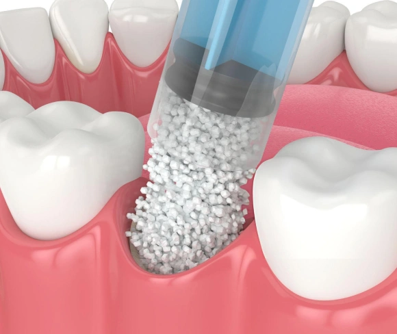 Dental implant procedure showing bone graft material being placed in jawbone between teeth.