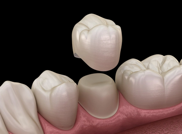 Dental crowns displayed on model gums showing tooth restoration and cosmetic dentistry solutions.