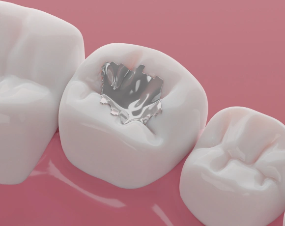 Three white dental crowns displayed on pink background, center crown shows tooth decay cavity illustration.