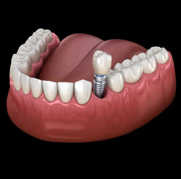 Dental implant model showing artificial tooth fixture integrated into gum tissue and surrounding natural teeth.