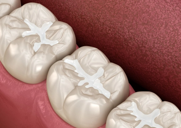 Three dental crowns displayed on pink background showing anatomical tooth surface details.