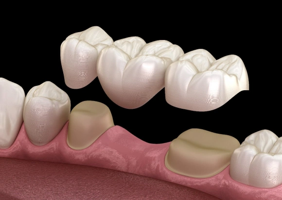 3D dental implant illustration showing crown placement on gum tissue model against black background.