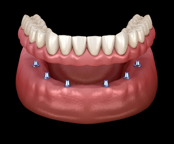 3D dental implant model showing full arch prosthetic teeth secured on lower jawbone with implant posts.