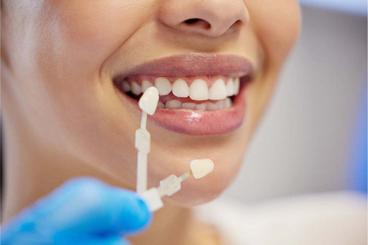 No-Prep Veneers Explained for Lubbock Residents A 2026 Smile Trend