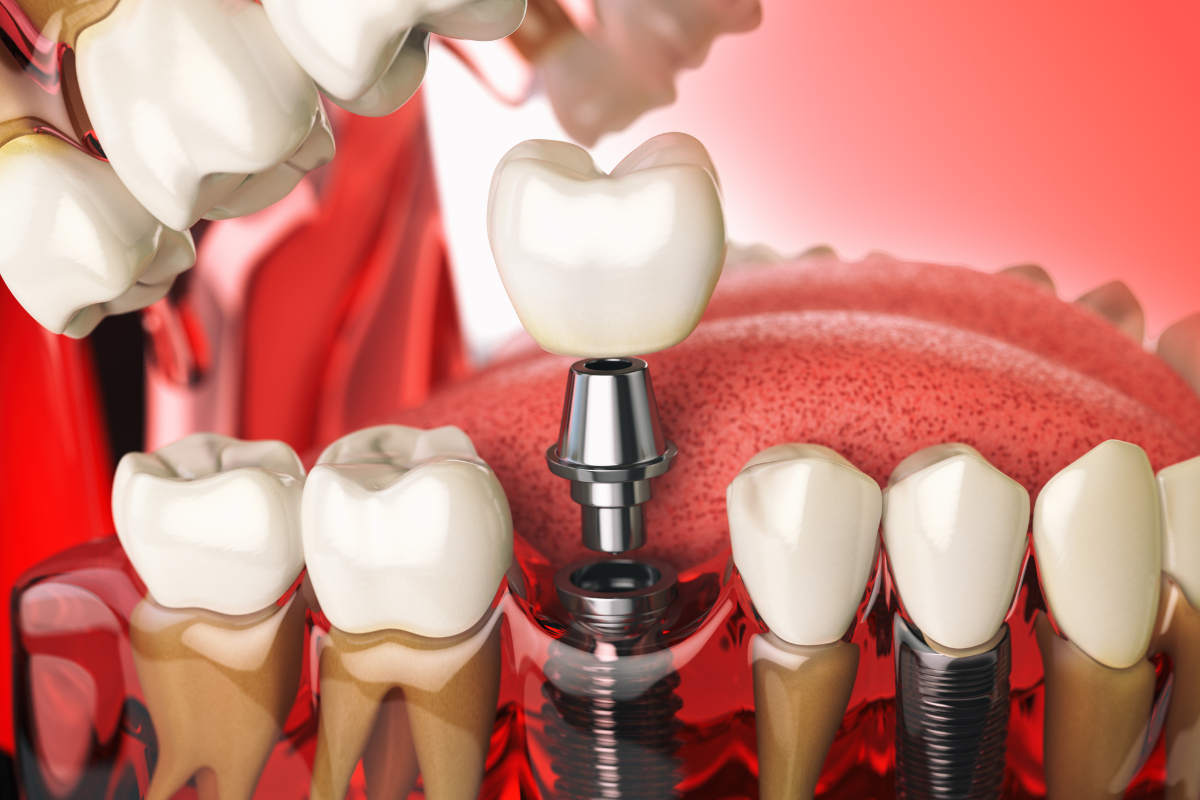 Why More Adults in West Texas Are Choosing Dental Implants in 2026
