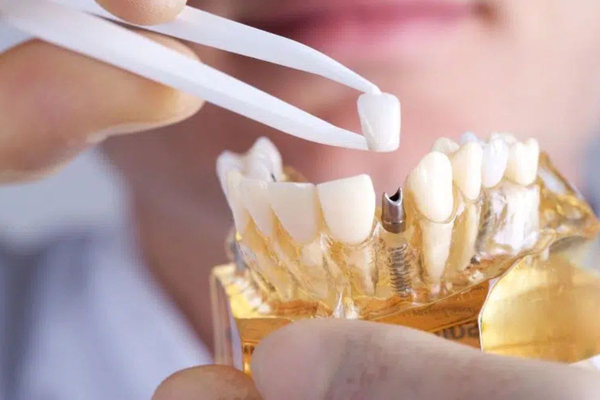 Dental implant model showing tooth replacement options with ceramic crowns and metal implant post.